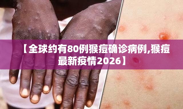 【全球约有80例猴痘确诊病例,猴痘最新疫情2026】